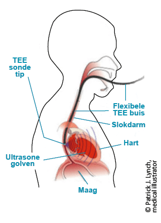 Bovenlichaam met afbeelding slokdarm, hart en maag en uitleg hoe de flexibele TEE buis via een TEE sondetip en ultrasone golven een echocardiogram maakt